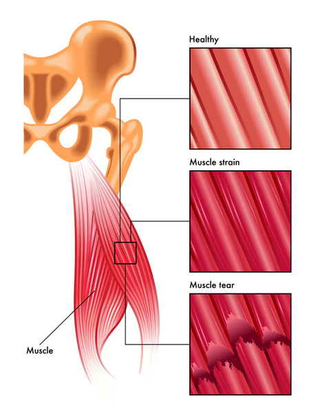 tensión y desgarro muscular
 - Vector, Imagen