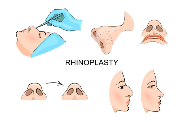 plastic neus. cosmetische chirurgie. - Vector, afbeelding