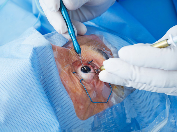 Μάτι χειρουργική επέμβαση close-up - Φωτογραφία, εικόνα