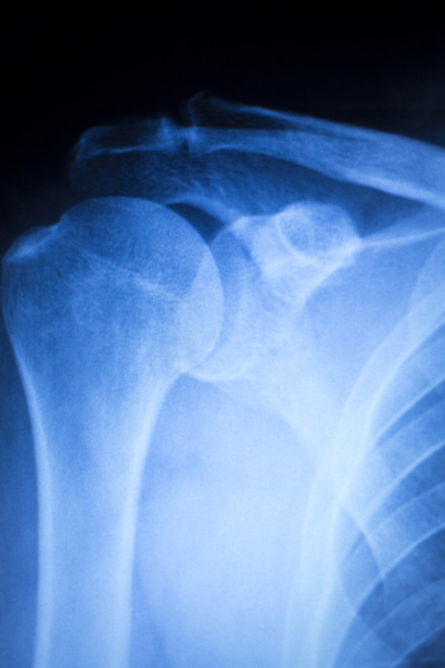 Schulterverletzung Orthopädie Röntgenbild - Foto, Bild