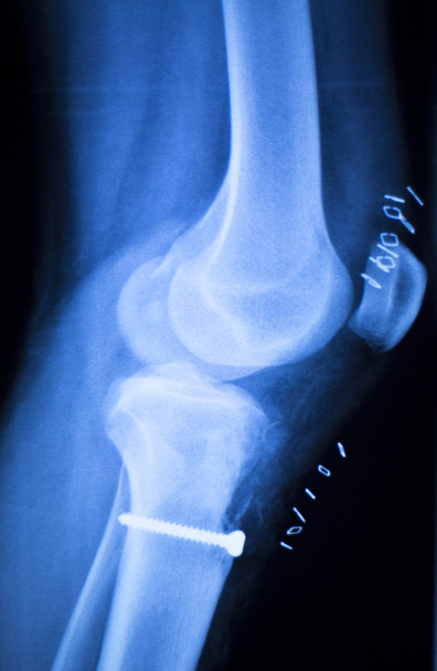 Examen de rayos X de menisco articular de rodilla
 - Foto, Imagen