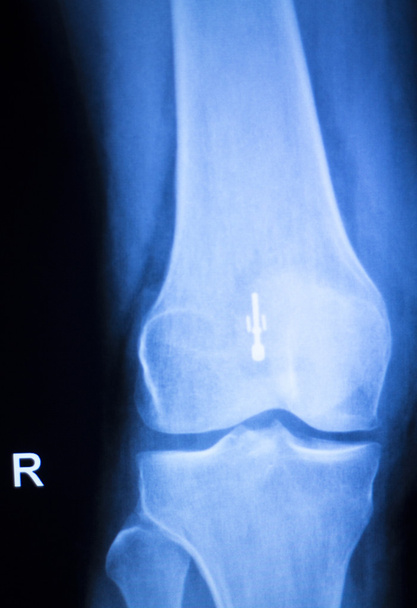 Knee joint implant x-ray test scan - Photo, Image