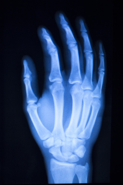 Hand Finger Daumen Krankenhaus Röntgenbild - Foto, Bild