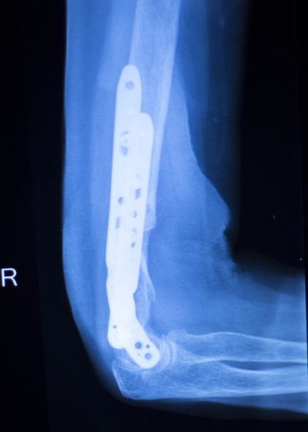 Exploración de rayos X del codo del brazo del implante quirúrgico
 - Foto, Imagen