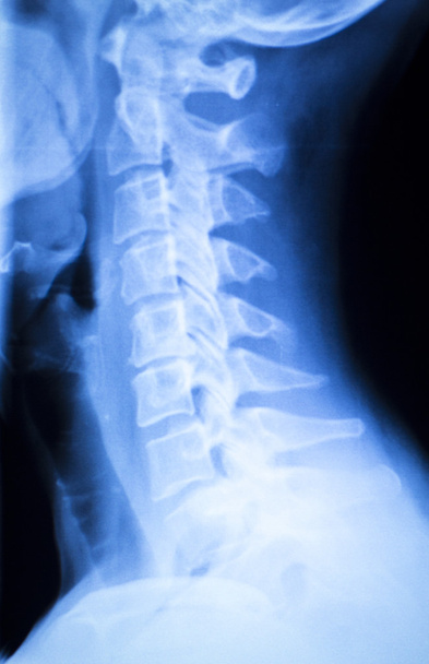Röntgenbild von Verletzungen am Hals und an der Wirbelsäule - Foto, Bild
