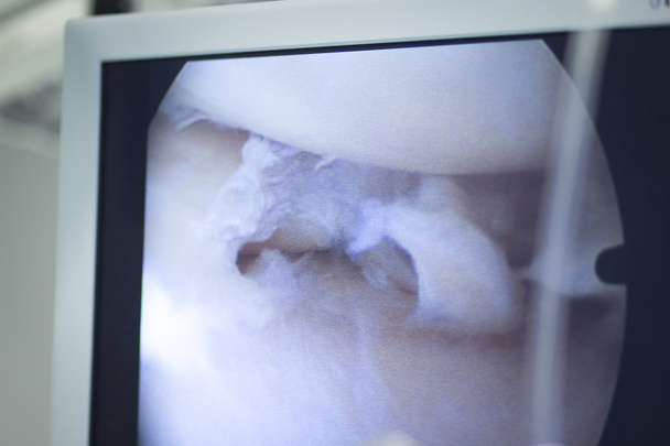 Ziekenhuis chirurgie artroscopie operatie scherm - Foto, afbeelding