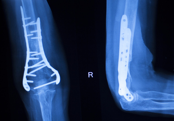 chirurgisches Implantat Arm Ellbogen Röntgenuntersuchung - Foto, Bild