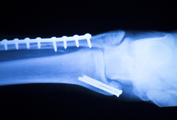 Tornozelo do pé e varredura de raio-x da canela
 - Foto, Imagem