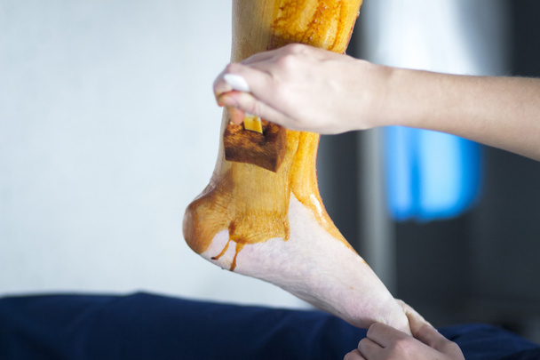 Αποστείρωση πόδι για Χειρουργικής Γόνατος ορθοπεδικά - Φωτογραφία, εικόνα