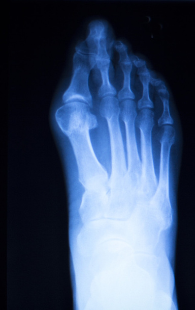 Lábfej és lábujjak kár röntgen vizsgálat - Fotó, kép