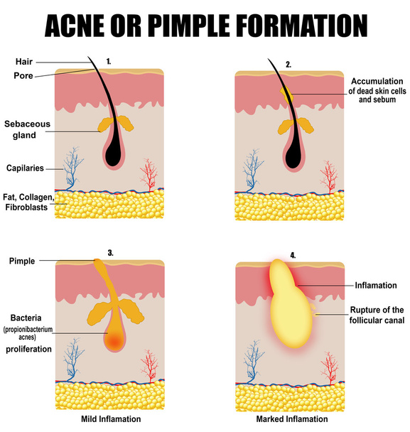 Formation of skin acne or pimple - Vector, Image