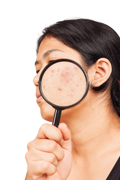  women show acne on skin with magnifier - 写真・画像