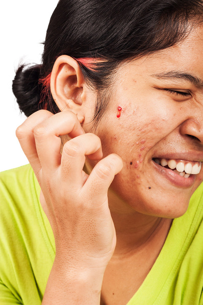 acne on skin face women - Photo, Image