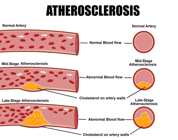 detaillierte Stadien der Arteriosklerose - Vektor, Bild