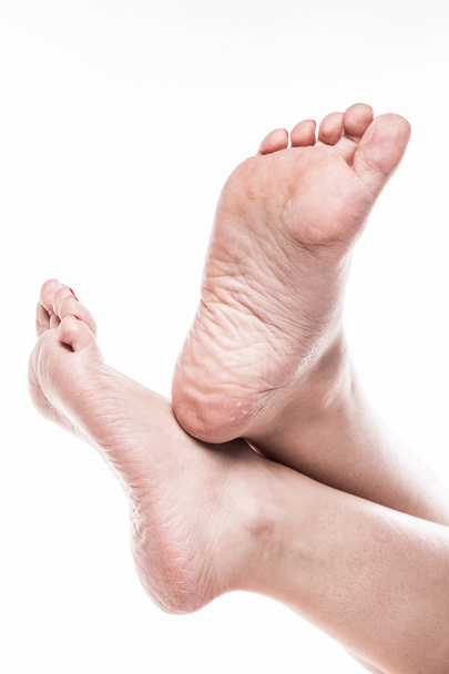 female foot with pedicure and poor over-dry skin on the heels of - Fotó, kép
