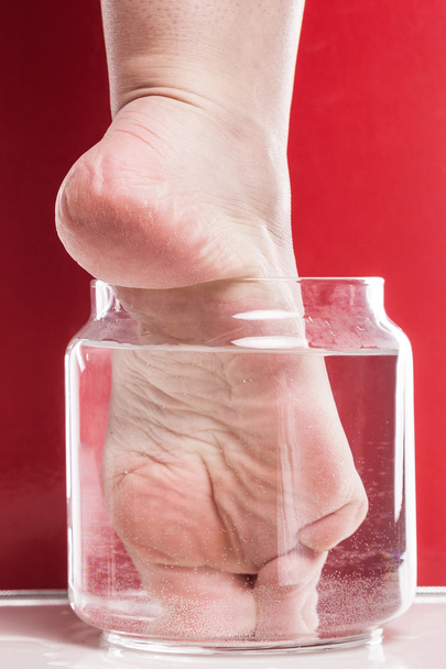 foot girl with a dry and rough skin and calluses on the heel moi - Fotoğraf, Görsel