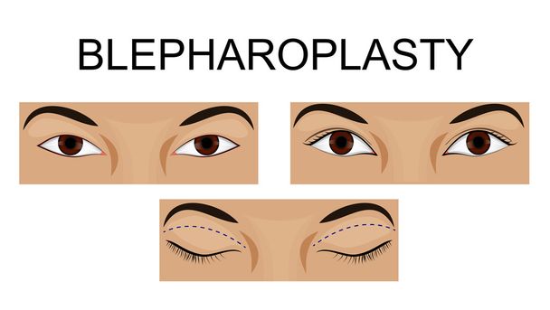 upper eyelid blepharoplasty - Vector, Image