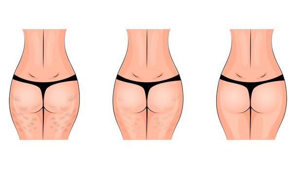 cellulite, cellulitis. buttocks - Vector, Image