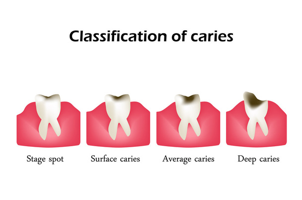 Types of dental caries. Infographics. Vector illustration on isolated background - Vector, Image