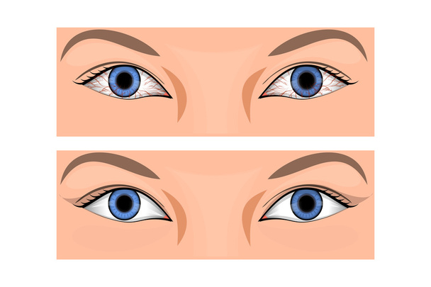 vermelhidão do olho
 - Vetor, Imagem