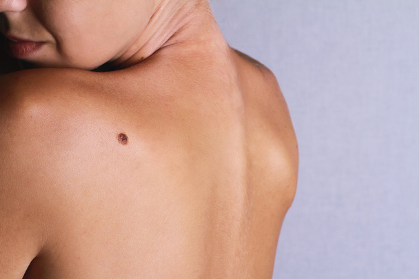 Checking benign moles : Young woman looking  with birthmark on her back / skin.  - Φωτογραφία, εικόνα