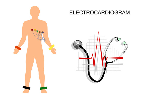 ΗΚΓ, ο ασθενής με τα ηλεκτρόδια στο στήθος. - Διάνυσμα, εικόνα