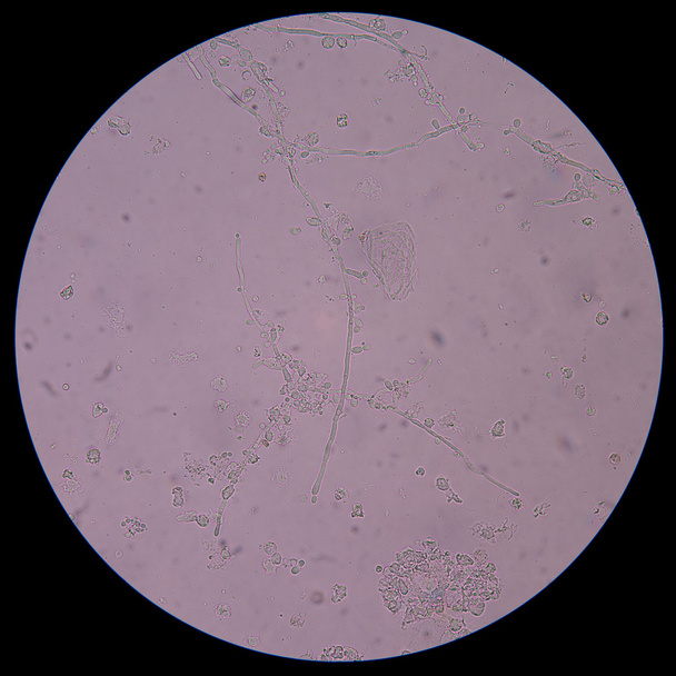 Oksastava orastava hiiva solujen pseudohyfae virtsassa
 - Valokuva, kuva