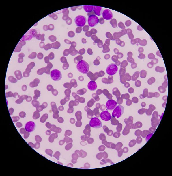 血液塗抹標本は異常な結果をフォロー アップ テストとしてよく使用されます。 - 写真・画像