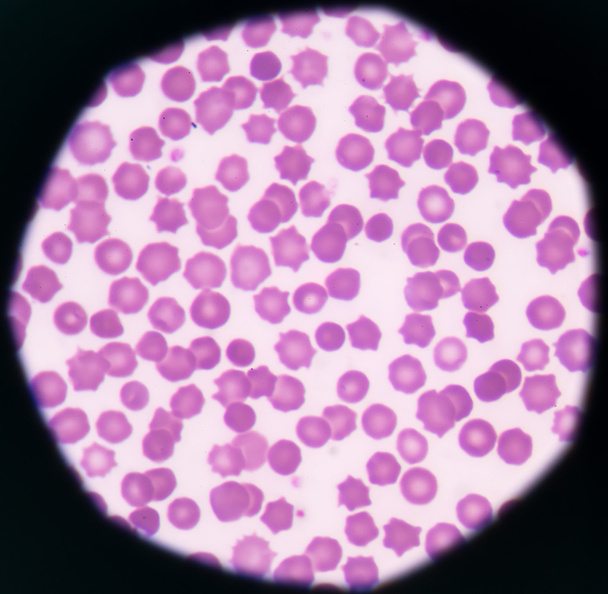 Κύτταρα ανώμαλη blod κόκκινο αστέρι σχήμα ιατρικό ιστορικό. - Φωτογραφία, εικόνα