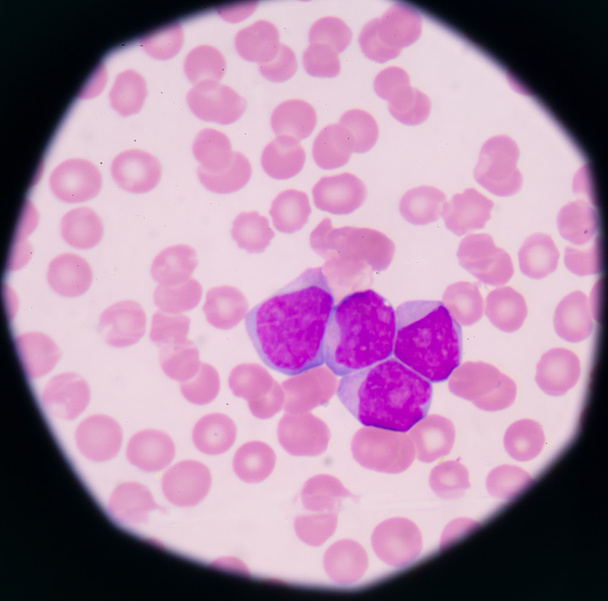 ブラスト細胞 (急性骨髄性白血病を示す医学背景) - 写真・画像