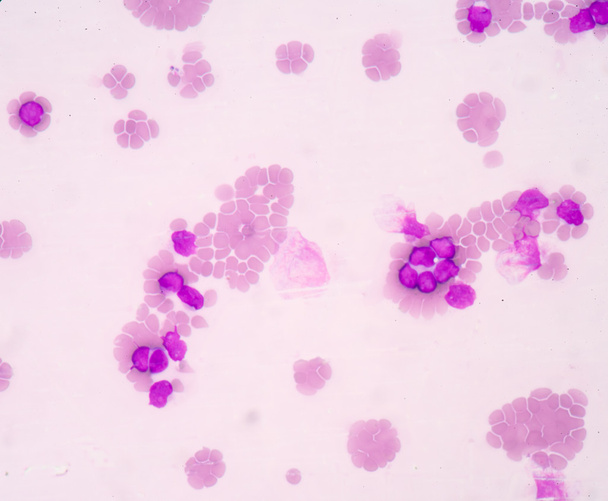 Achtergrond van de medische wetenschap toont blast cellen (Aml) - Foto, afbeelding