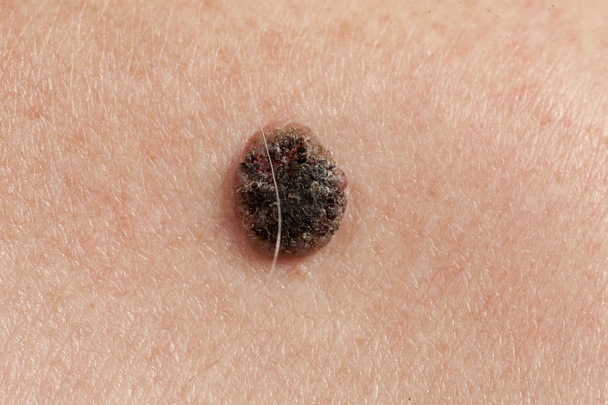 carcinoma a cellule squamose cheratinizzanti della pelle
 - Foto, immagini