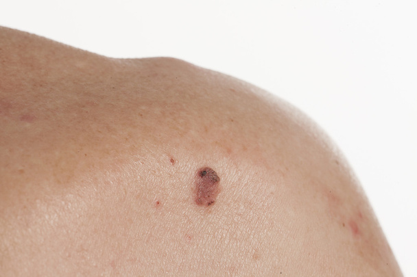 carcinoma espinocelular queratinizante da pele
 - Foto, Imagem