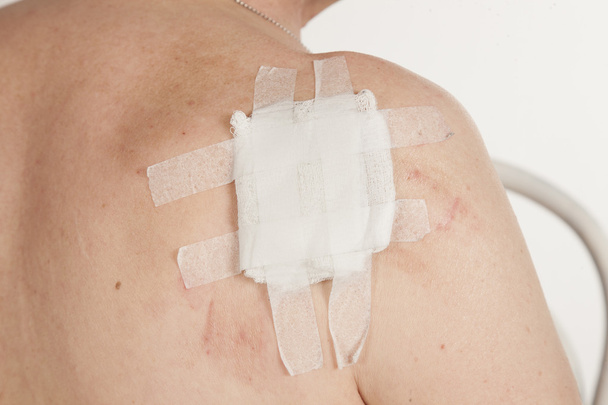 carcinome épidermoïde kératinisant de la peau
 - Photo, image