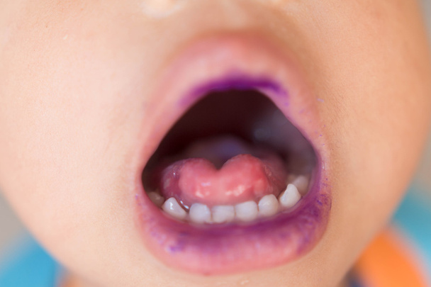 Заболевание полости рта у ребенка
 - Фото, изображение