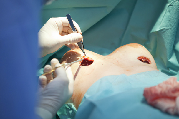 rintojen suurentaminen leikkaus leikkaussalissa kirurgi työkalut implantti
 - Valokuva, kuva