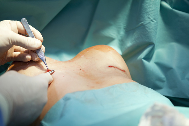 borst vergroting chirurgie in de operatiekamer chirurg tools implantaat - Foto, afbeelding