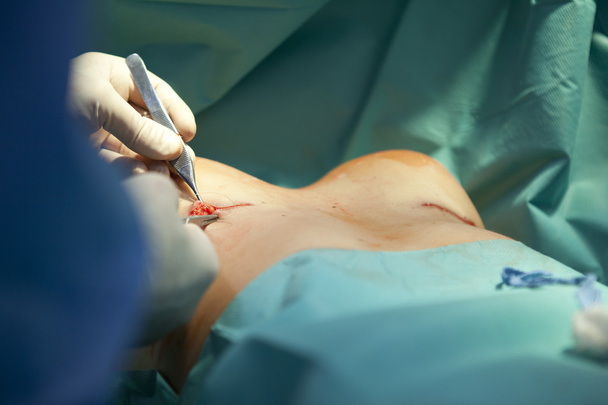 breast augmentation surgery in the operating room surgeon tools implant - Foto, Imagen