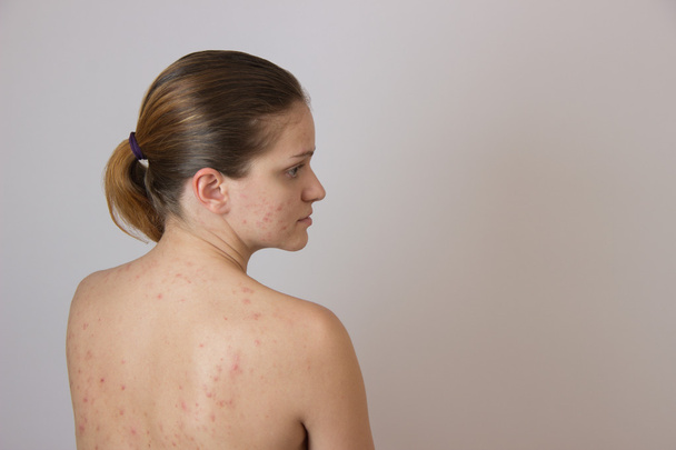 Menina bonita com acne em seu rosto e as costas em um whi
 - Foto, Imagem