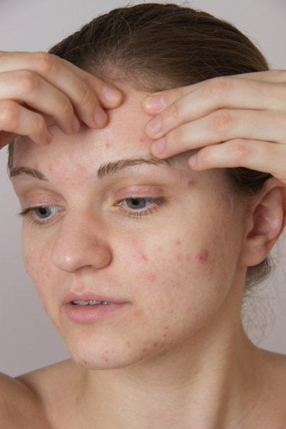 Beautiful young girl with acne on his face and the back on a whi - Foto, Bild