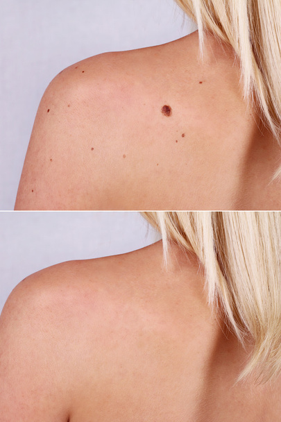 Laser treatment for birthmark removal before and after.  - 写真・画像
