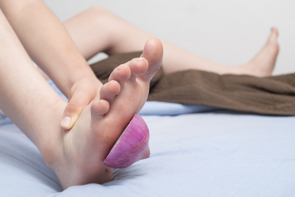 Fatias de cebola no pé como tratamento médico
 - Foto, Imagem