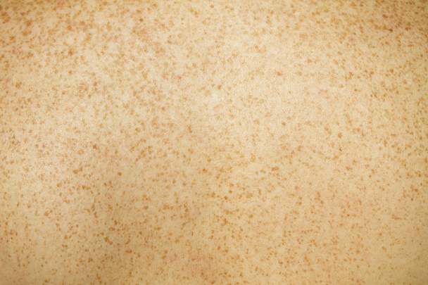 Freckled terug huid - Foto, afbeelding