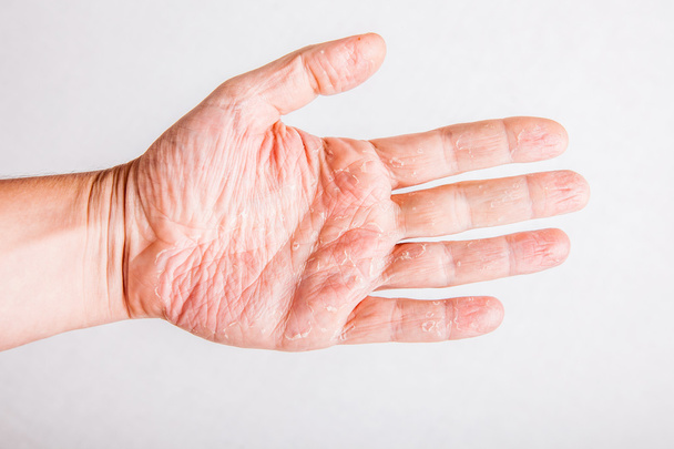 eczema atopic dermatitis symptom skin texture - Foto, Imagen