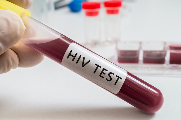 HIV test - test tube with blood in laboratory. - 写真・画像