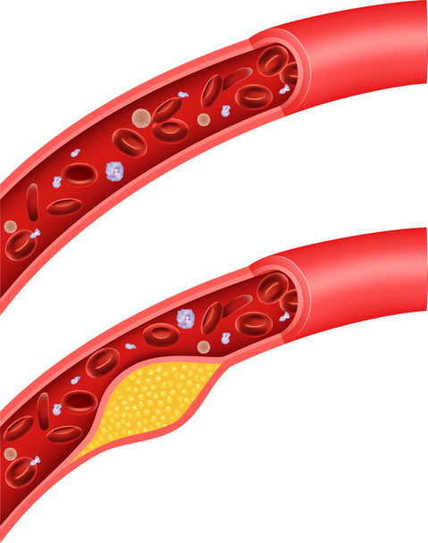 Illustration of cholesterol blocking artery - Vector, Image