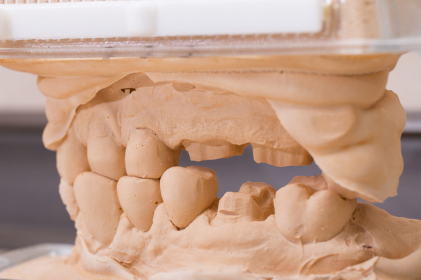 石膏で歯の歯石膏モデル金型 - 写真・画像
