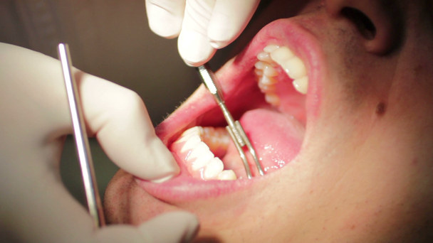 Diş hekimi - hasta Close-up açık ağız ağız muayenesi sırasında - Video, Çekim