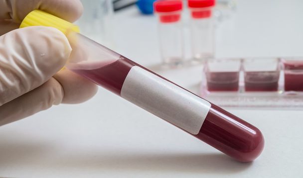 Blood in test tube. Researcher is analyzing blood. - Photo, Image